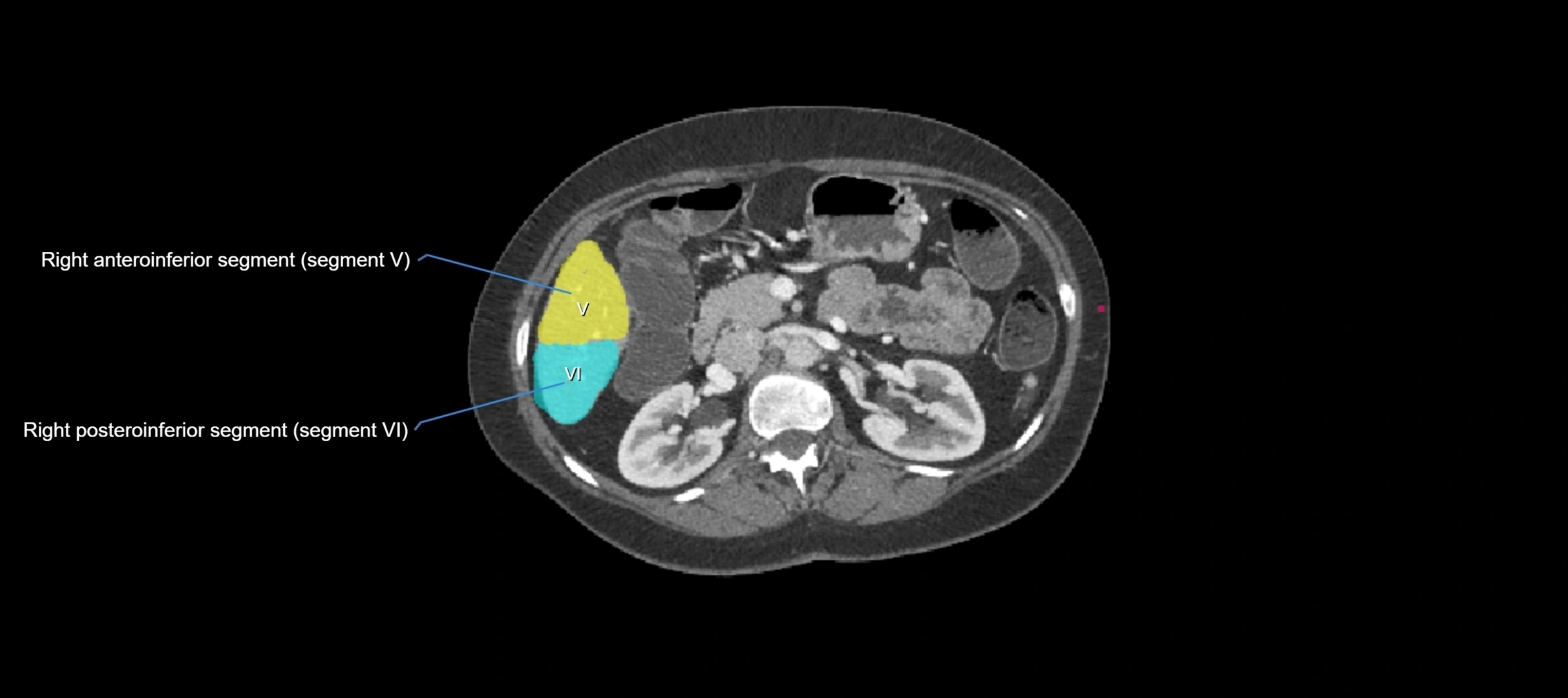 CT liver segments axial cross sectional anatomy labelled image-00024.webp